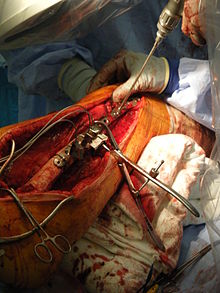 جراحی ارتوپدی (به انگلیسی: Orthopedic surgery)